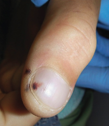 Is manicure and pedicure contraindicated for splinter hemorrhage?