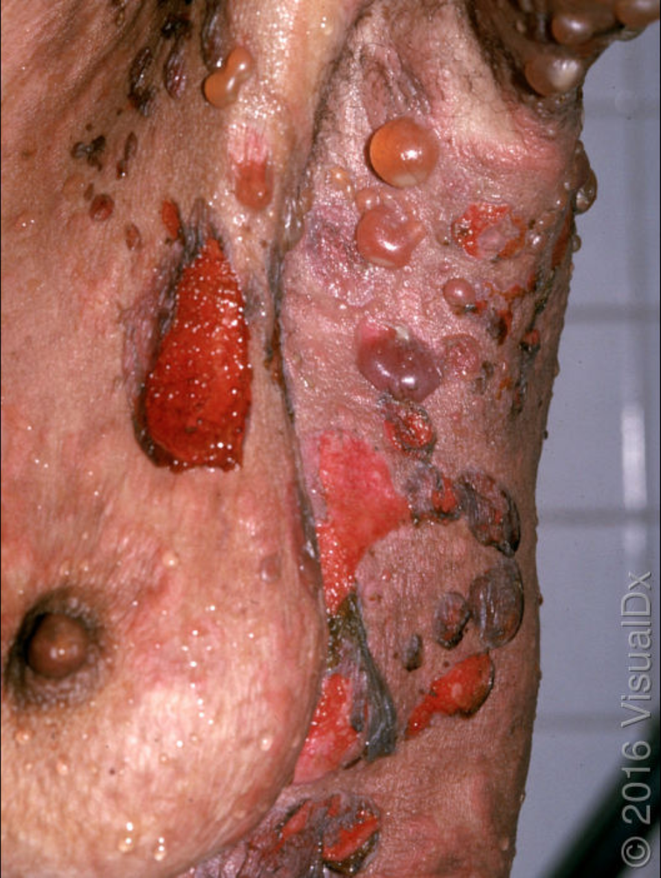 pink sock disease