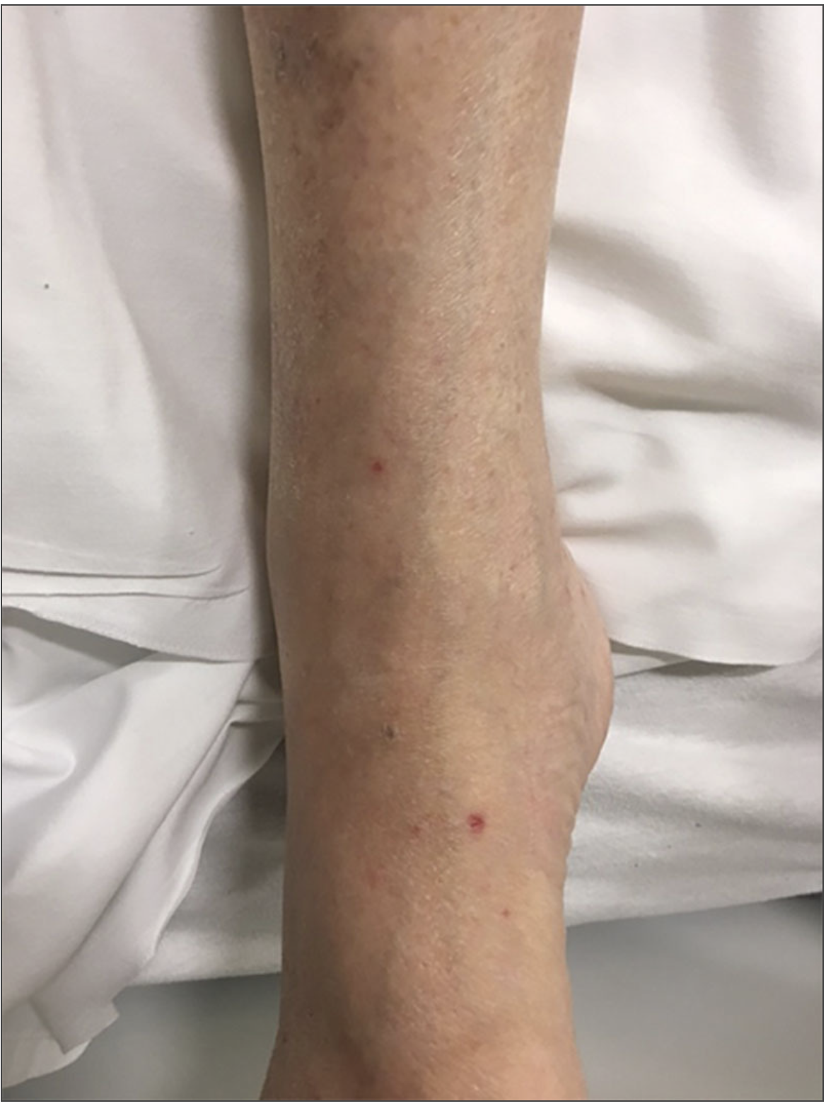 Disseminated Gonorrhea Rash